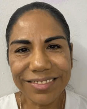 After Botox cosmetic treatment