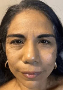 Before Botox cosmetic treatment