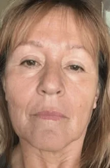 After Sculptra facial rejuvenation