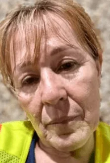 Before Sculptra facial rejuvenation